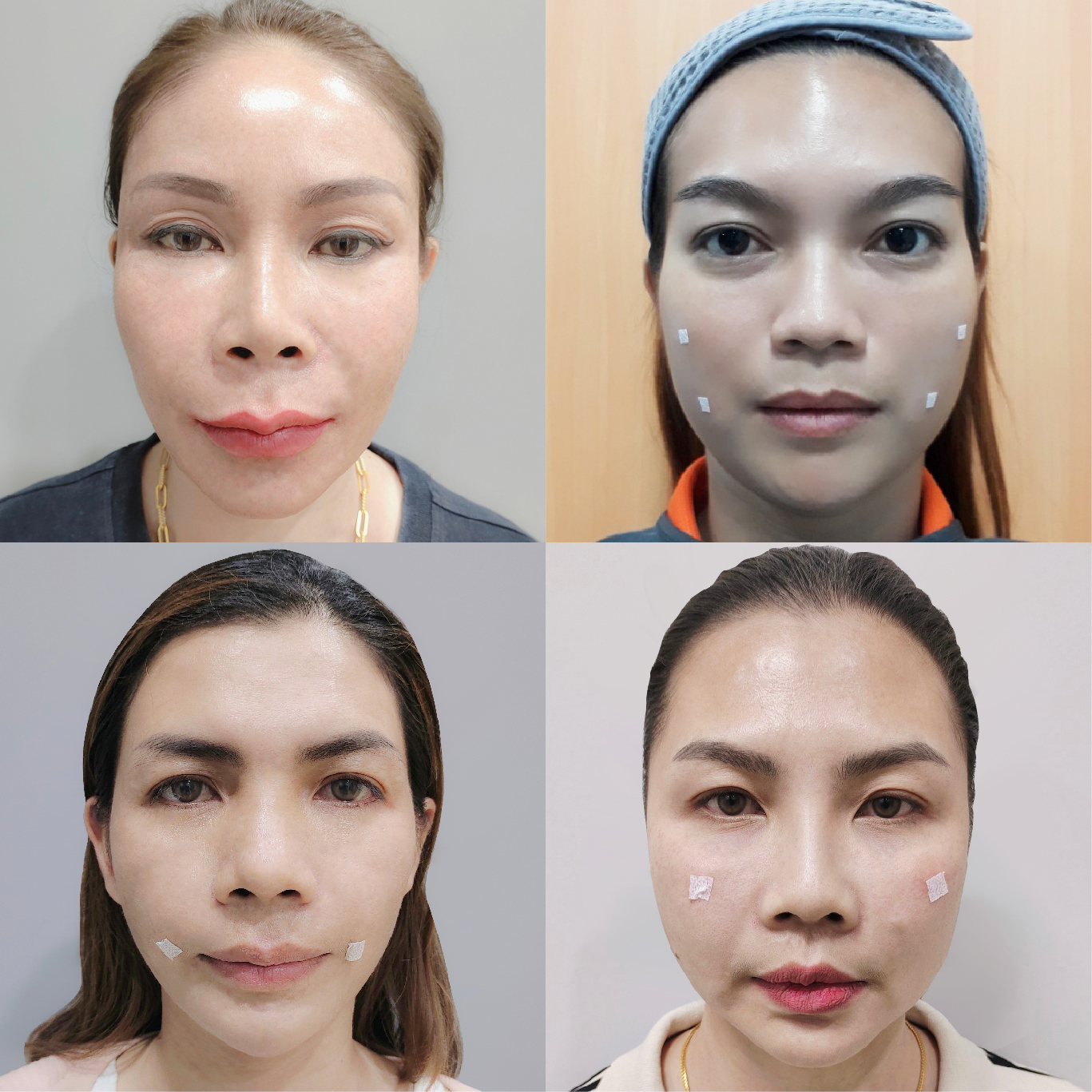 รวมรีวิวเติมฟิลเลอร์ร่องแก้ม